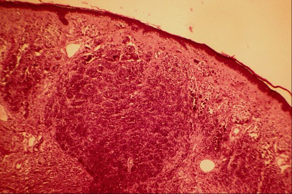 440069 Intradermal Naevus A4 Photo Print