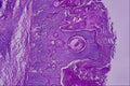 440070 Papillomatous Naevus A4 Photo Print