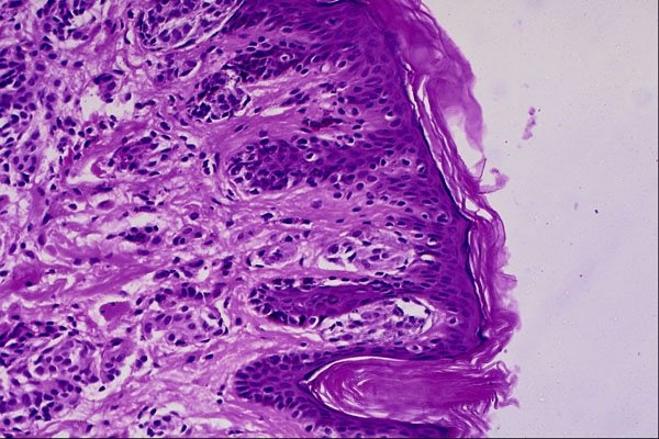 440071 Compound Neavus A4 Photo Print
