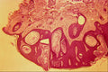 440074 Basal Cell Papaloma A4 Photo Print