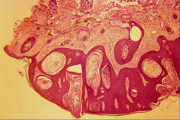 440074 Basal Cell Papaloma A4 Photo Print