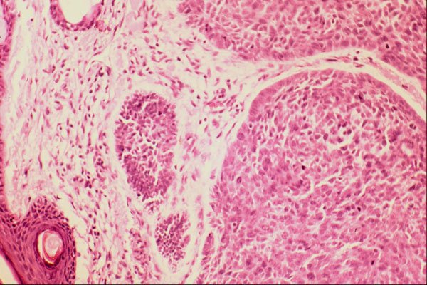 440075 Basal Cell Carcinoma A4 Photo Print