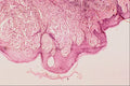 440076 Malignant Melanoma A4 Photo Print