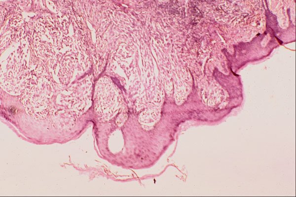 440076 Malignant Melanoma A4 Photo Print