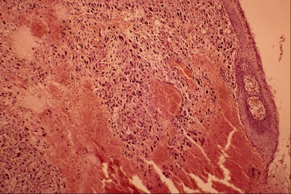 440077 Unpigmented Malignant Melanoma A4 Photo Print