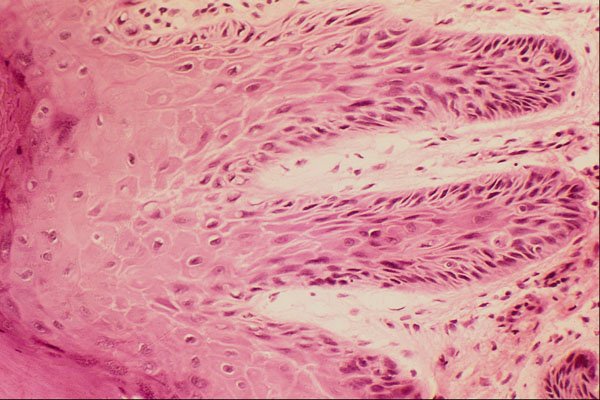 440078 Senile Keratosis A4 Photo Print