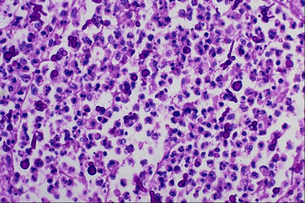 440081 Candida In Inflammatory Exudate A4 Photo Print