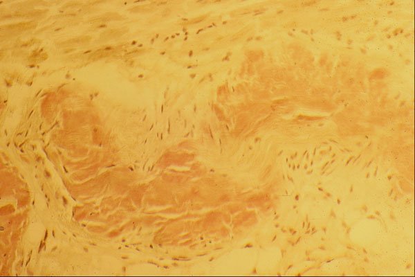 440083 Myocardium Amyloid A4 Photo Print
