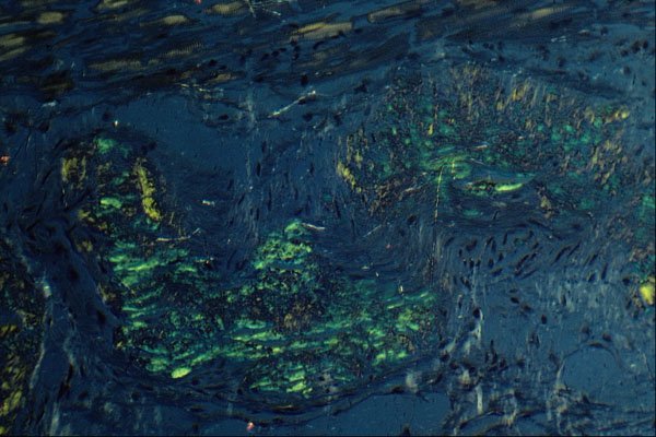 440084 Myocardium Amyloid, Polarised Light A4 Photo Print