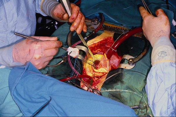 686044 Suturing In A New Valve, Valve Replacement Surgery A4 Photo Print