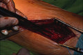 686087 Vascular Surgery A4 Photo Print