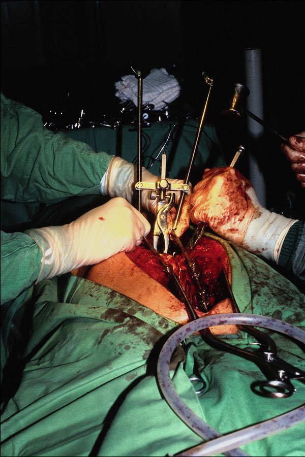 686088 Spinal Operation A4 Photo Print
