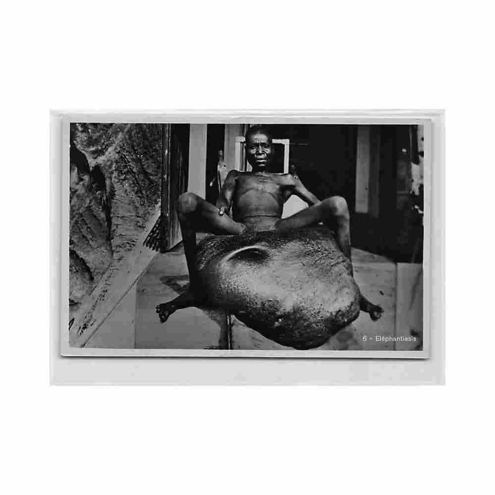 congo kinshasa africa that is disappearing tropical diseases elephantiasis c zagourski 6 Vintage A4 Photo Print