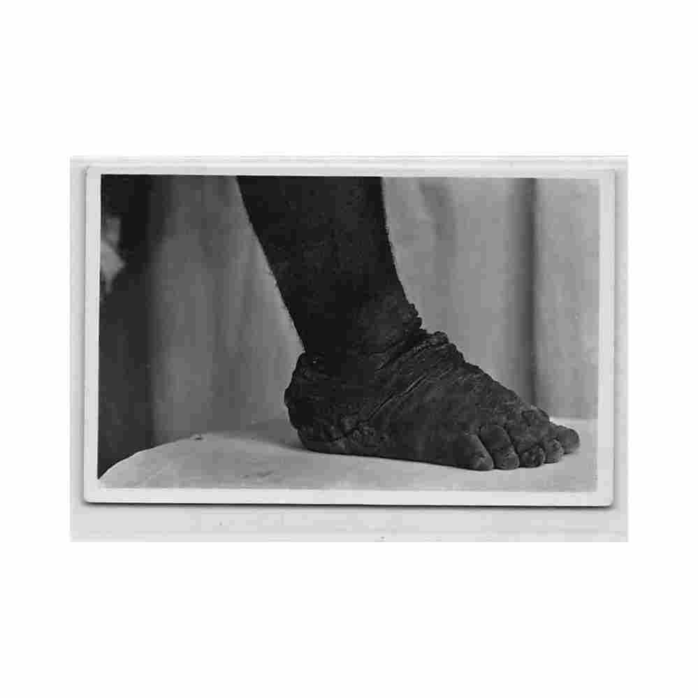 congo kinshasa maladies tropicales elephanthiasis carte l afrique qui disparait ed c zagourski Vintage A4 Photo Print