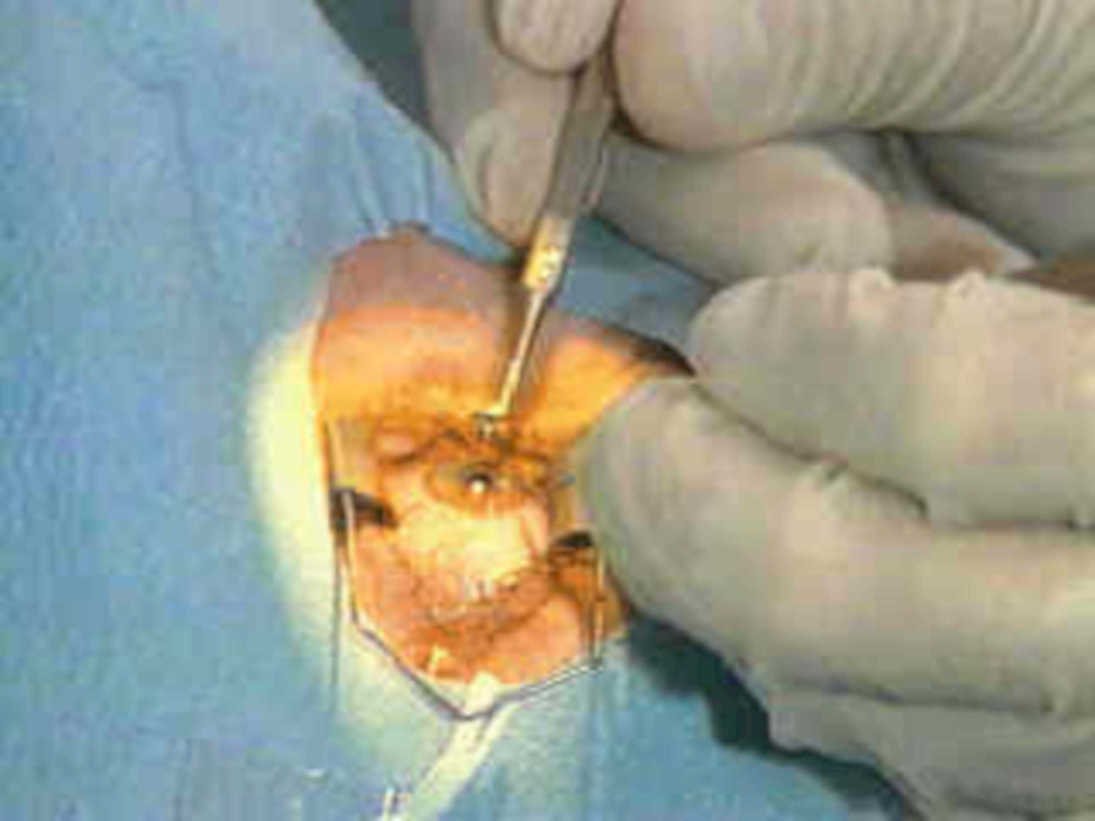 laparoscopic surgery forceps1980s 1990s A4 Photo Print